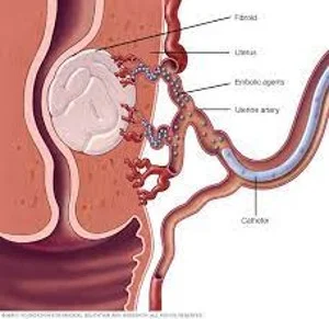 Adenomyosis surgery in Bhiwani, Haryana by Dr. Seema Bhardwaj, providing advanced surgical treatment for relief from symptoms.